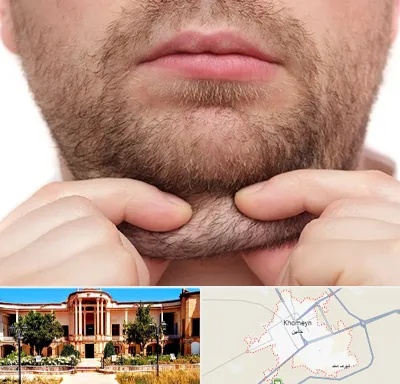ساکشن غبغب در خمین