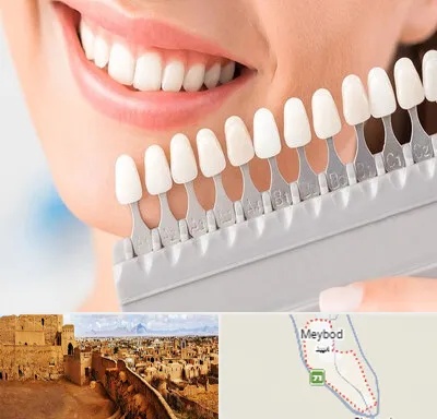 متخصص لمینت دندان در میبد