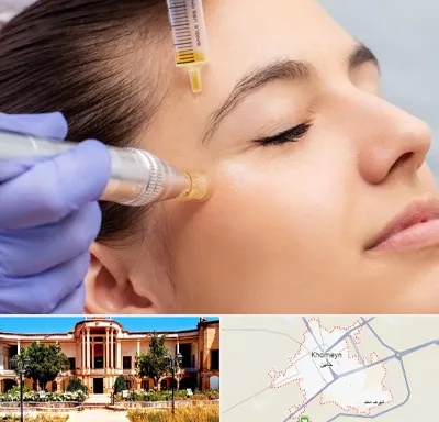 میکرونیدلینگ در خمین