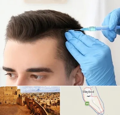 مزوتراپی مو در میبد