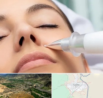 پلاسما جت بینی در اسدآباد