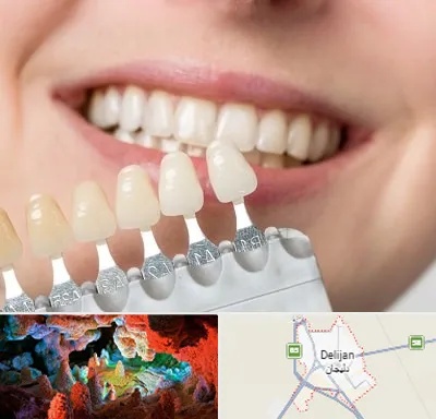 مرکز کامپوزیت دندان در دلیجان