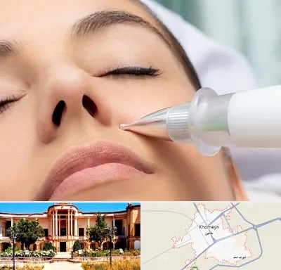 پلاسما جت بینی در خمین