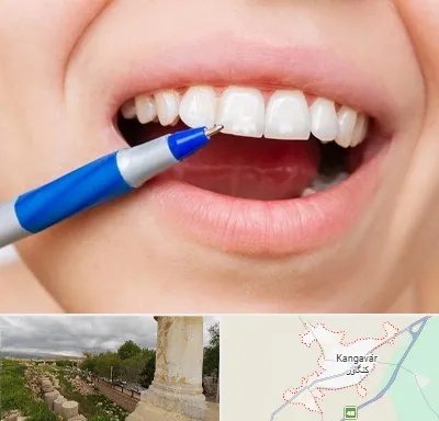 دندانسازی ارزان در کنگاور