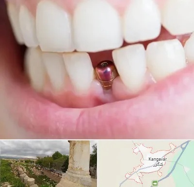ایمپلنت اقساطی در کنگاور