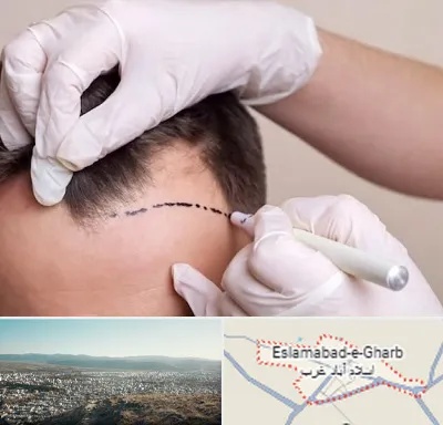 کاشت مو به روش SUT در اسلام آباد غرب