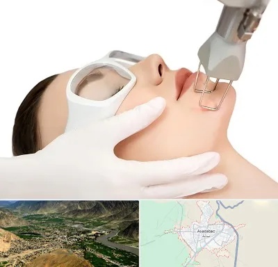 لیزر فرکشنال در اسدآباد