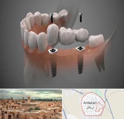 ایمپلنت دیجیتال در اردکان