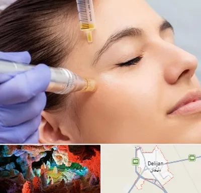 میکرونیدلینگ در دلیجان