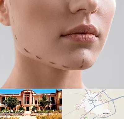 عمل زاویه فک در خمین