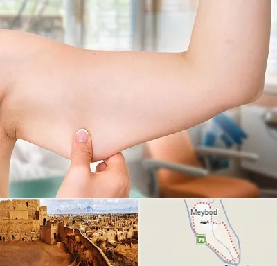 براکیوپلاستی در میبد