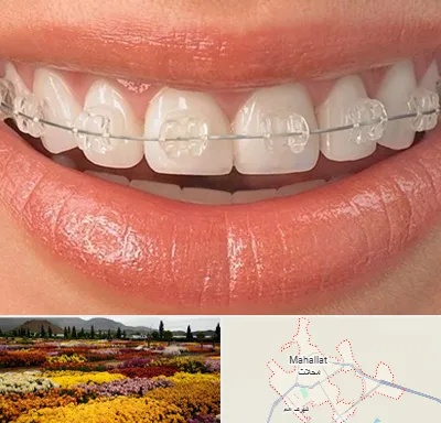 ارتودنسی اقساطی در محلات
