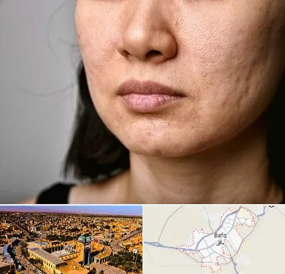 سابسیژن جای جوش در بافق