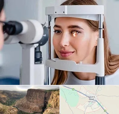 دکتر قوز قرنیه در سرپل ذهاب