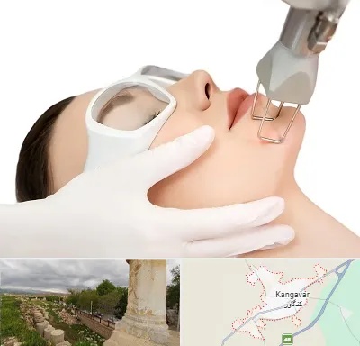 لیزر فرکشنال در کنگاور