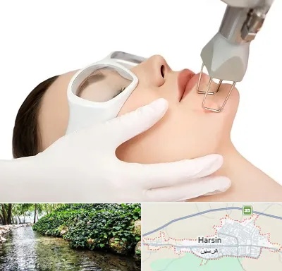 لیزر فرکشنال در هرسین