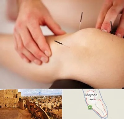 دکتر طب سوزنی برای لاغری در میبد