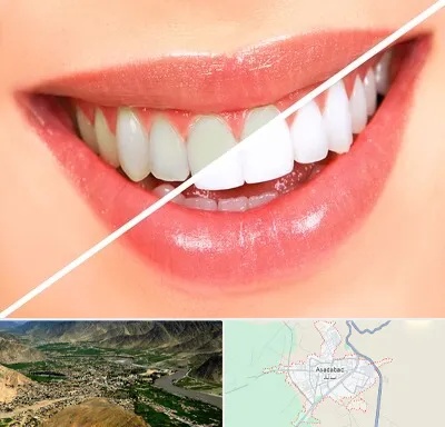 بلیچینگ دندان در اسدآباد