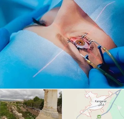 عمل prk چشم در کنگاور