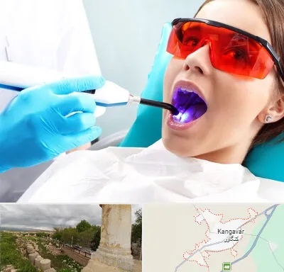 جراحی لثه با لیزر در کنگاور