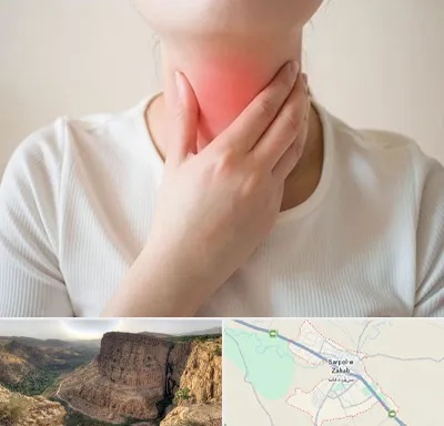 دکتر سرطان مری در سرپل ذهاب