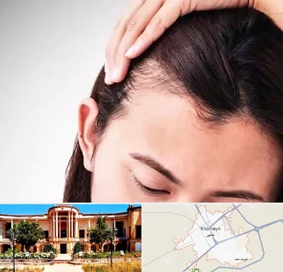 کاشت مو بانوان در خمین