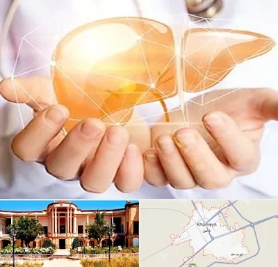 دکتر سرطان کبد در خمین
