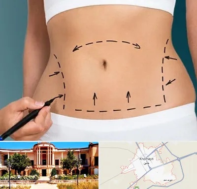 عمل ابدومینوپلاستی در خمین