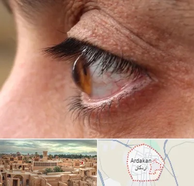 متخصص قوز قرنیه در اردکان
