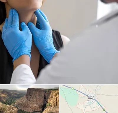 دکتر سرطان گلو در سرپل ذهاب