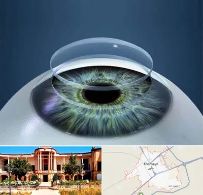 پیوند قرنیه در خمین