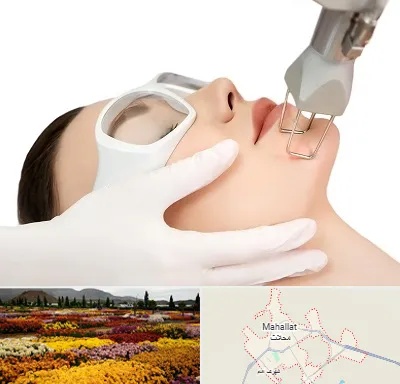 لیزر فرکشنال در محلات