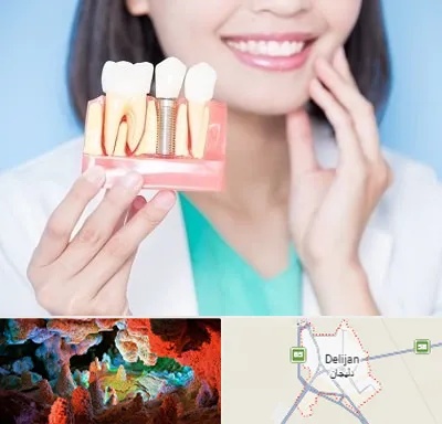 متخصص ایمپلنت در دلیجان