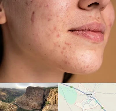 درمان جای جوش در سرپل ذهاب