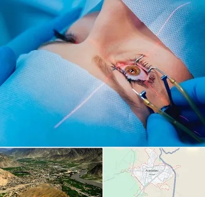 عمل prk چشم در اسدآباد