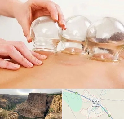 بادکش درمانی در سرپل ذهاب