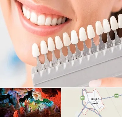 متخصص لمینت دندان در دلیجان