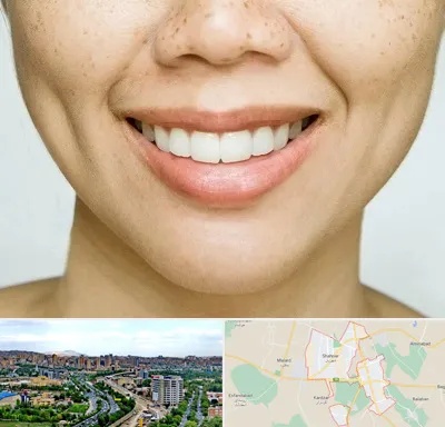 عمل چال گونه در شهریار