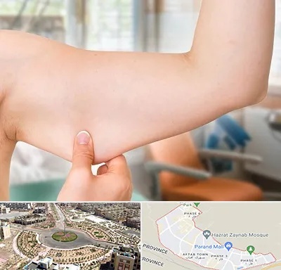 براکیوپلاستی در پرند
