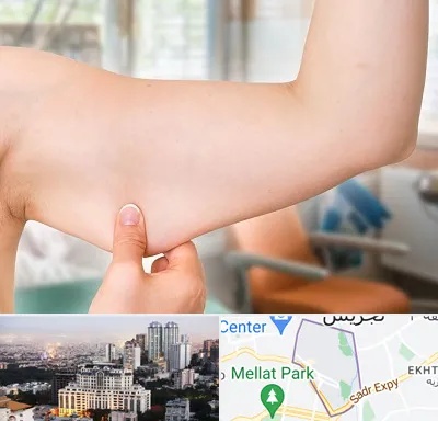 براکیوپلاستی در الهیه 