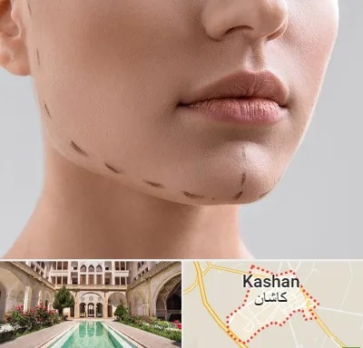عمل زاویه فک در کاشان