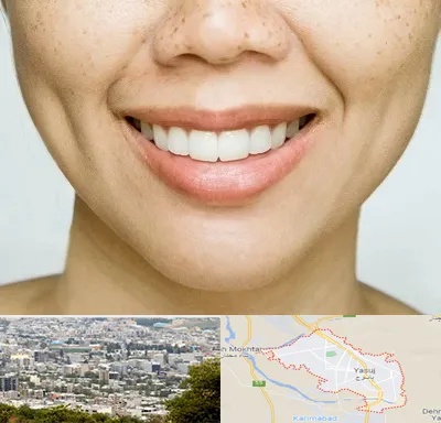 عمل چال گونه در یاسوج