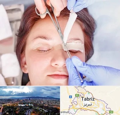 جراحی پلک افتاده در تبریز