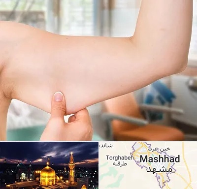 براکیوپلاستی در مشهد