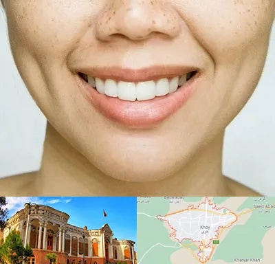 عمل چال گونه در خوی