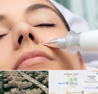 پلاسما جت بینی در اکباتان 