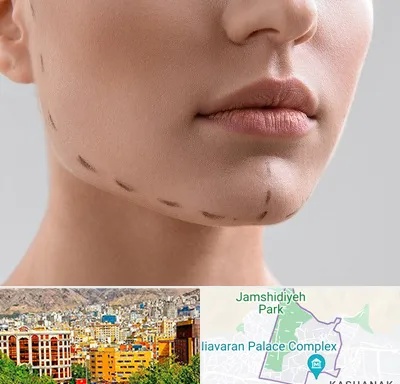 عمل زاویه فک در نیاوران 