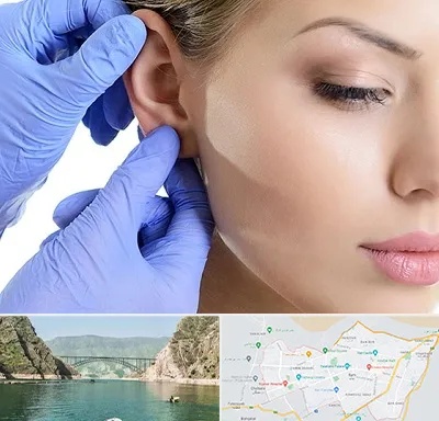 اتوپلاستی در ایلام