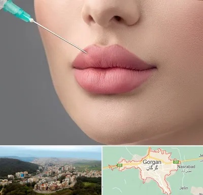 کلینیک ژل لب روسی در گرگان