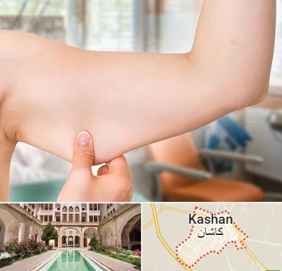 براکیوپلاستی در کاشان